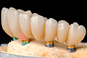 implantes 2
