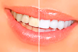 implantes 2