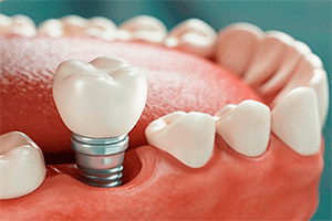 implantes 2
