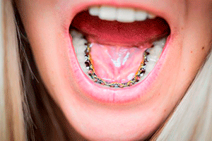 implantes 2