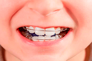 implantes 2